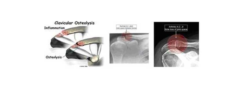 Injuries of the Acromioclavicular Joint