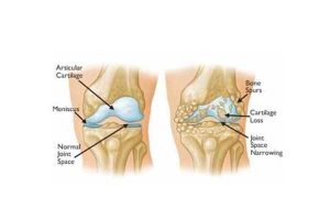Αρθρίτιδα του γόνατος - Οστεοαρθρίτιδα
