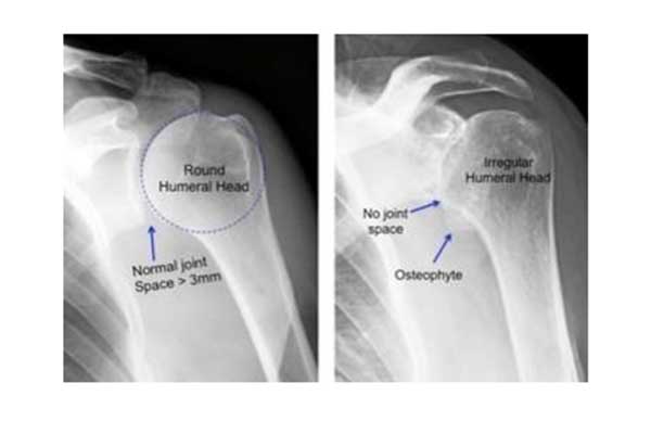 Shoulder Osteoarthritis and Shoulder Arthroplasty