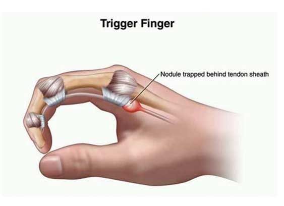 Trigger finger