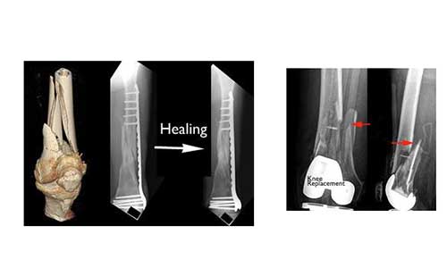 proximal tibia fracture