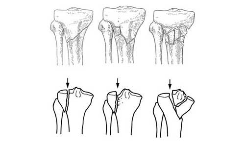 TIBIAL FRACTURES