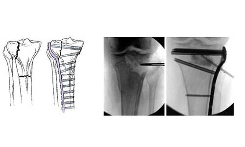 TIBIAL FRACTURES