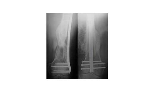FRACTURES OF THE DISTAL FEMUR