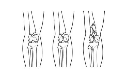 FRACTURES OF THE DISTAL FEMUR