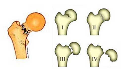 Femoral Neck Fractures