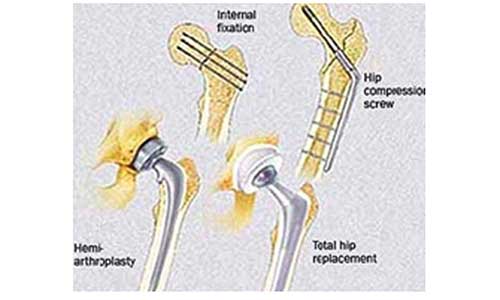 Femoral Neck Fractures