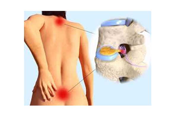 Intervertebral Disc Hernia - Herniated disk 
