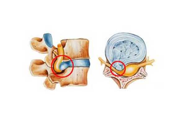Intervertebral Disc Hernia - Herniated disk 