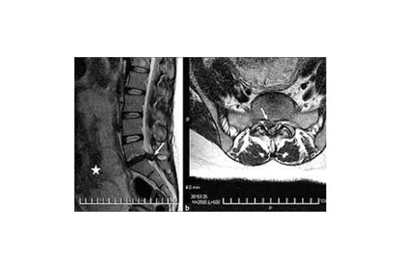 Intervertebral Disc Hernia - Herniated disk 