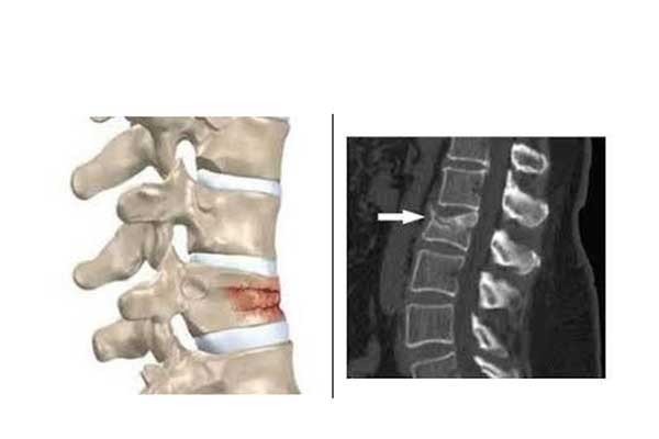 Kατάγματα της σπονδυλικής στήλης