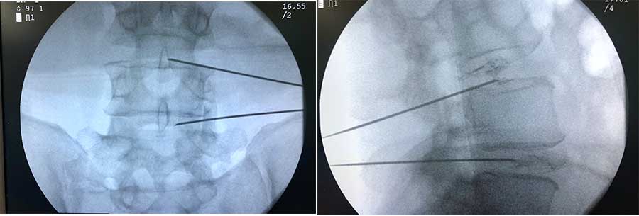 Intervertebral Disc Hernia - Herniated disk 