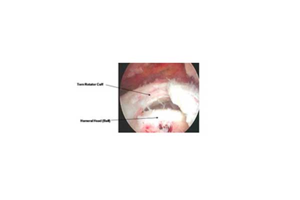 Supraspinatus tendon rupture