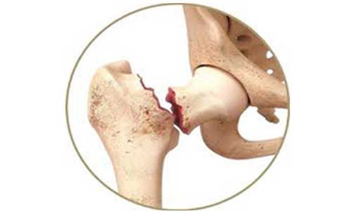 Femoral Neck Fractures