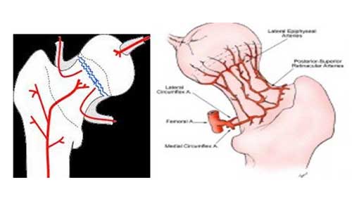 Femoral Neck Fractures